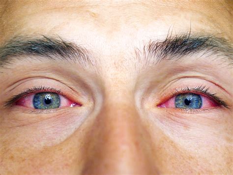 tear test infection clinic|blocked tear duct eye infection.